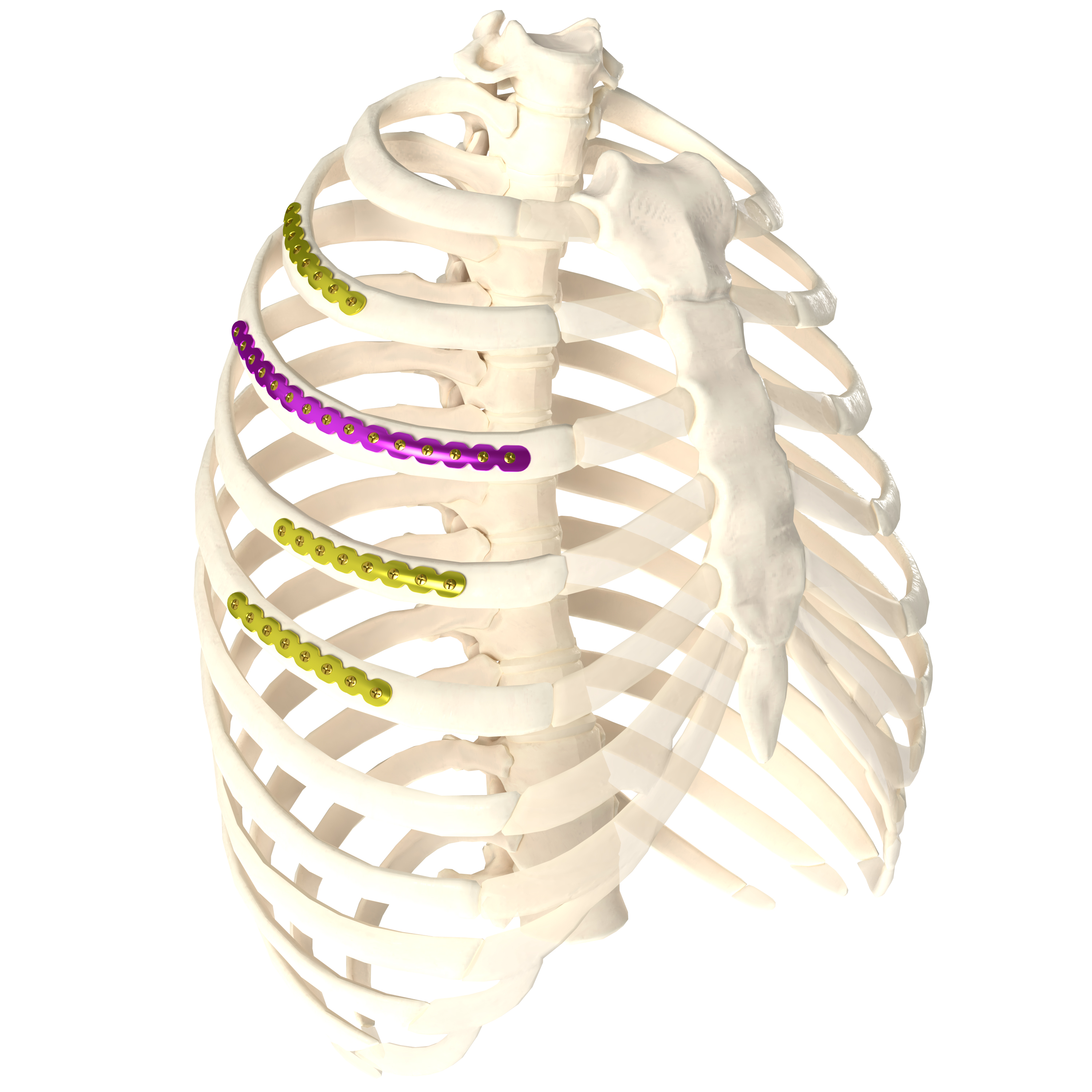 肋骨接骨板系統