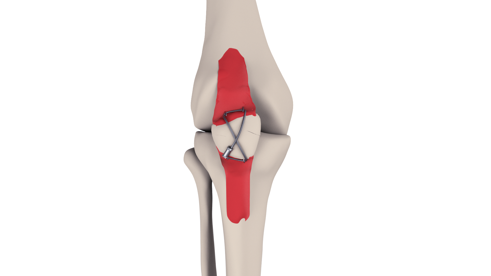 金屬纜索系統(tǒng)