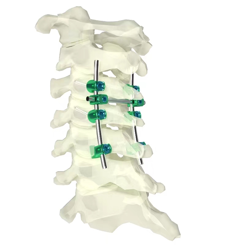 頸椎后路內固定系統